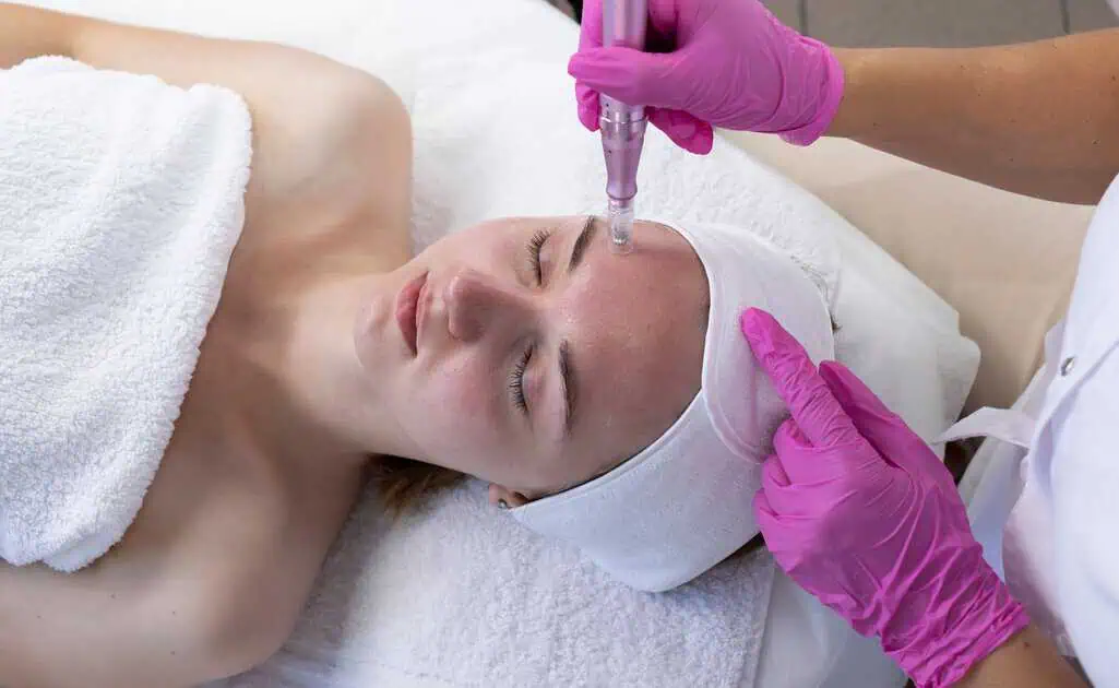 Microneedling in Markham, ON by The SENZU BEAN