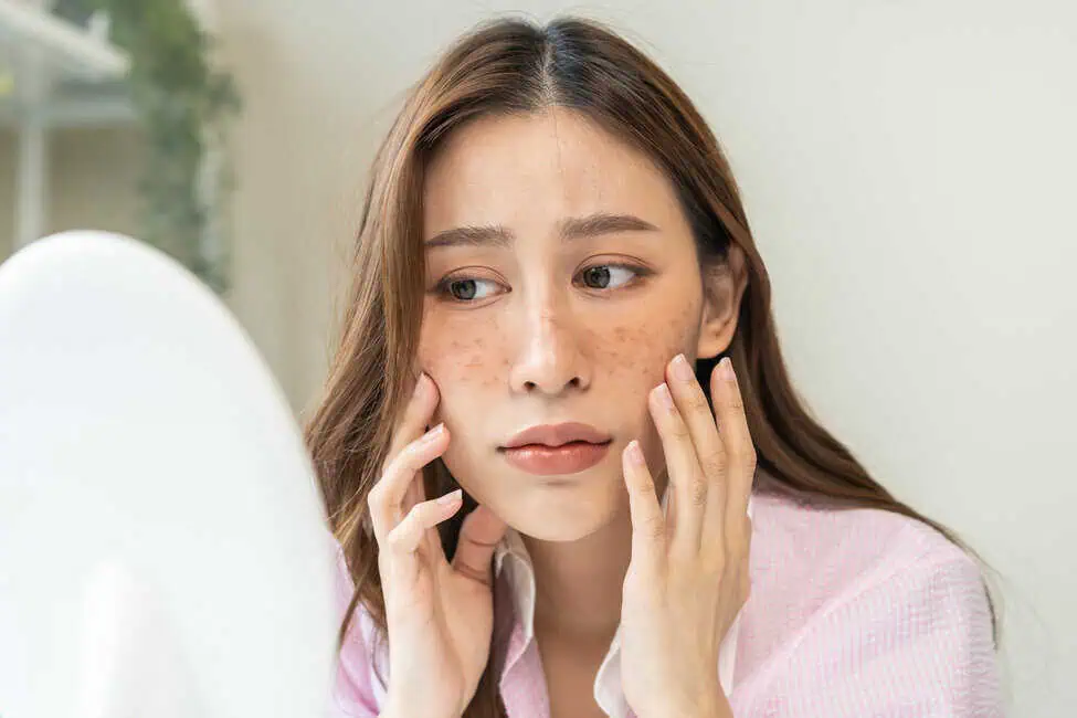 Age Spot Treatment by The Senzu Bean in Markham,ON