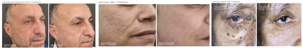 Aerolase® EraPeel
