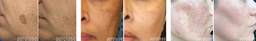 Aerolase® Neo Elite by Senzu Bean in Markham, ON