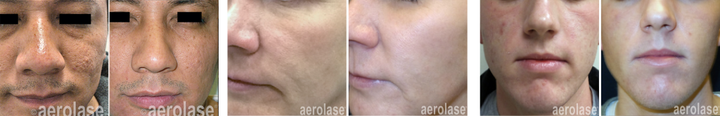 Aerolase® Neo Elite Before and after