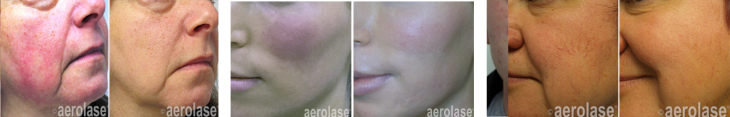 Aerolase® Neo Elite Women Before and After