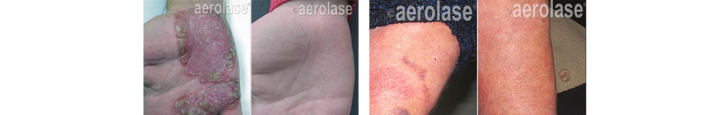 Before and After Aerolase® Neo Elite