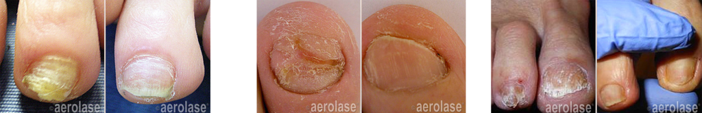 Aerolase® Neo Elite Before and After