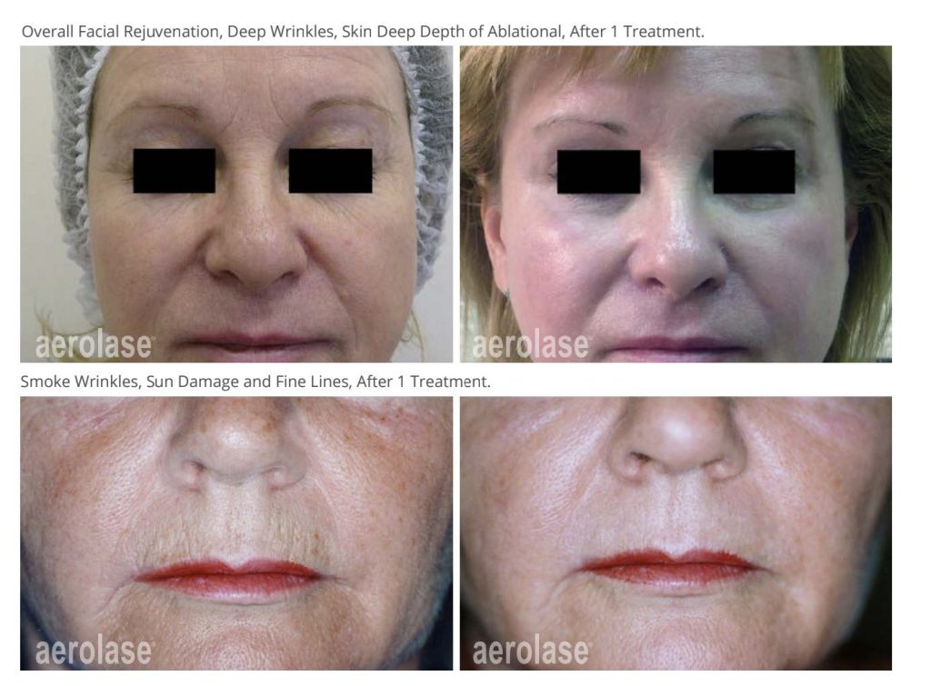 Aerolase® EraPeel Before and After