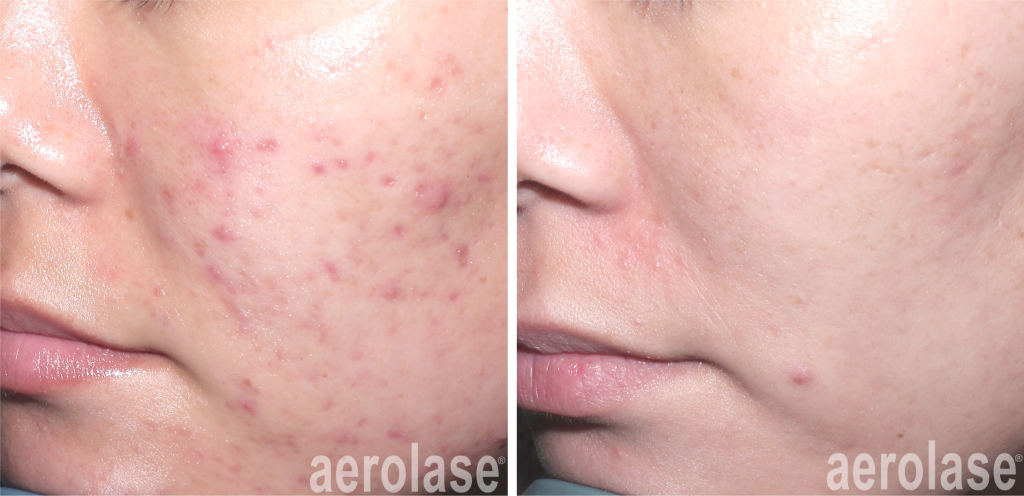aerolase acne spade before after