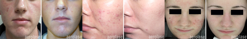 Aerolase® Neo Elite by Senzu Bean in Markham, ON