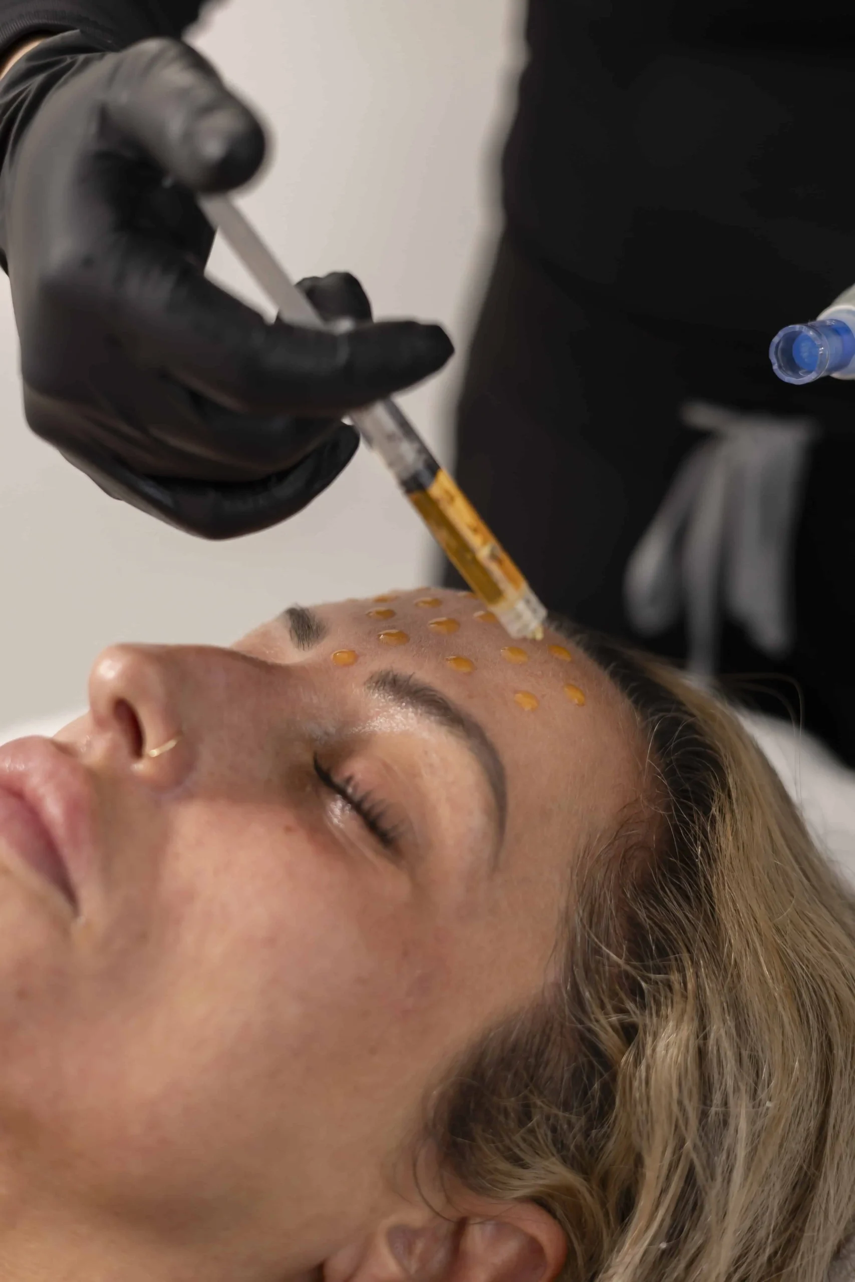 Injecting aesthetic solution into forehead for anti-aging enhancement