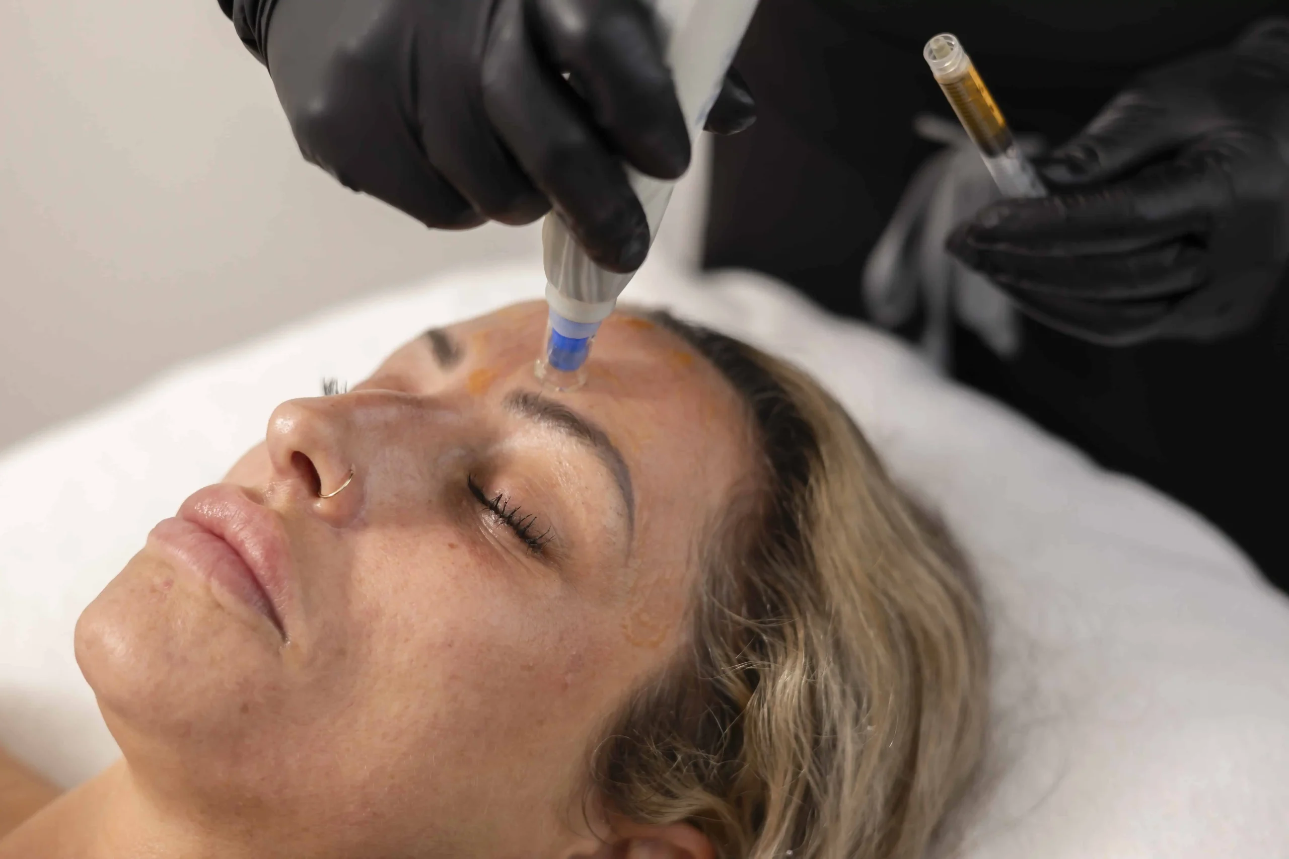 Close-up of forehead injection for wrinkle-reducing cosmetic procedure