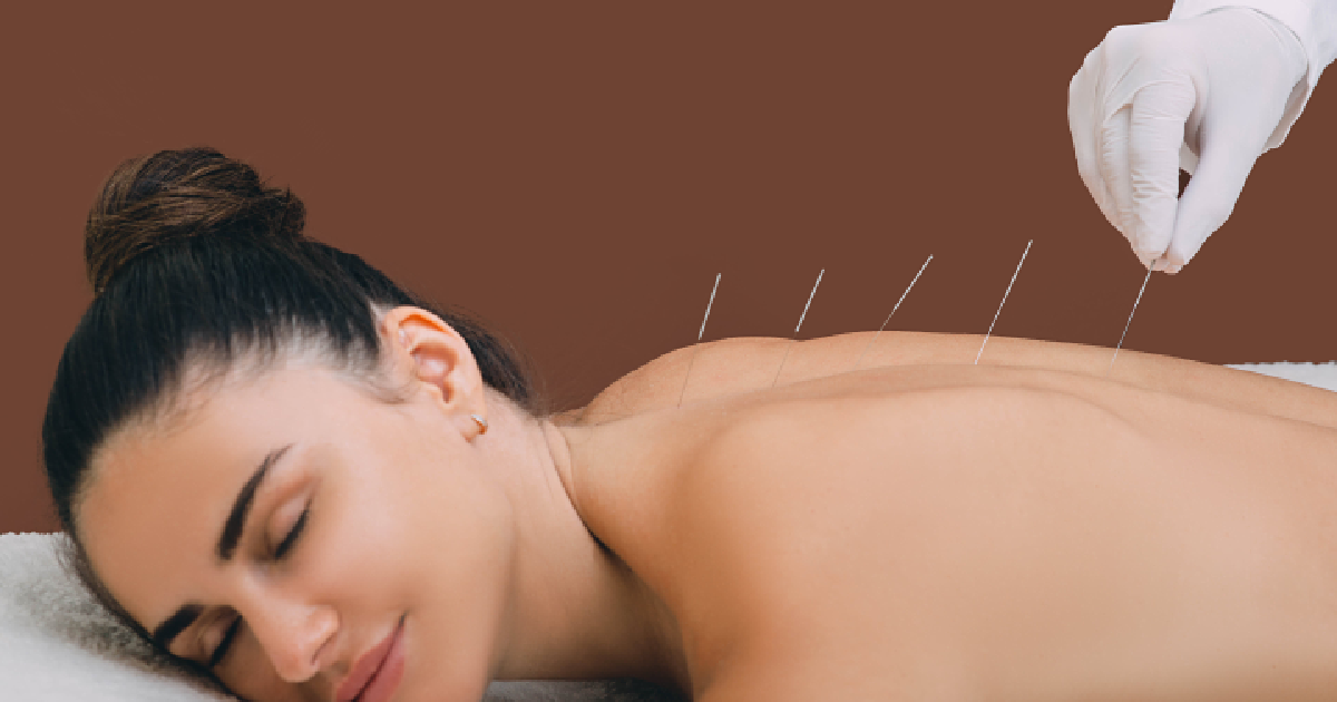 Relaxed woman receiving Acupuncture Therapy in Markham, ON, with fine needles placed along her upper back to promote healing and relieve tension.